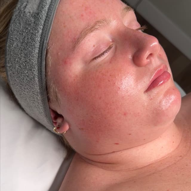 Dermaplaning + Ultimate glow at VELOUR in plantation, FL